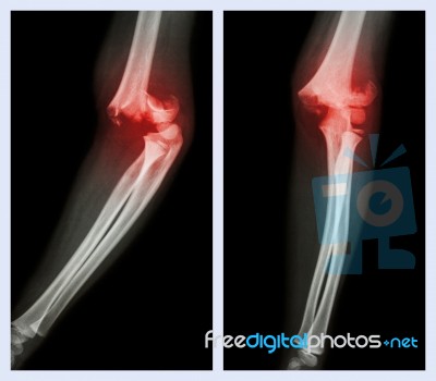 Fracture Elbow (left Image : Side Position , Right Image : Front Position) Stock Photo