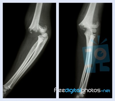 Fracture Elbow (left Image : Side Position , Right Image : Front Position) Stock Photo