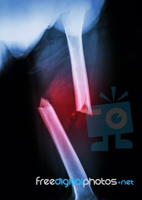 Fracture Femur Stock Photo