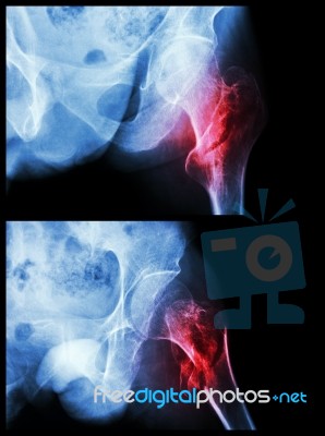 Fracture Head Of Femur(thigh Bone) (intertrochanteric Fracture)  (2 Position) Stock Photo