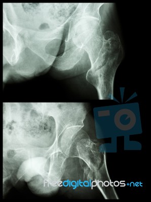 Fracture Head Of Femur(thigh Bone) (intertrochanteric Fracture)  (2 Position) Stock Photo