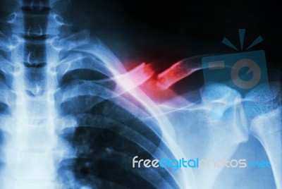 Fracture Left Clavicle Stock Photo