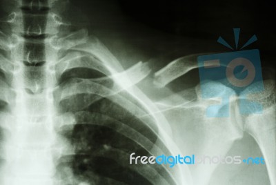 Fracture Left Clavicle Stock Photo