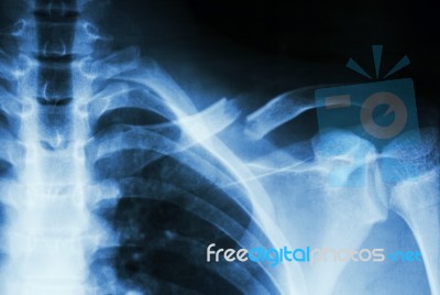 Fracture Left Clavicle Stock Photo