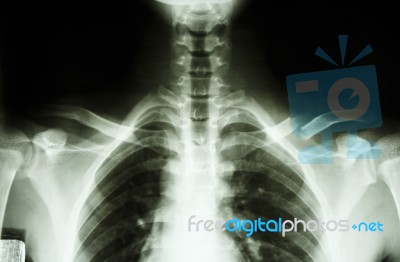 Fracture Middle 1/3 Left Clavicle Stock Photo