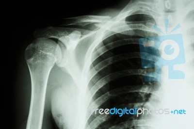 Fracture Middle Right Clavicle Stock Photo