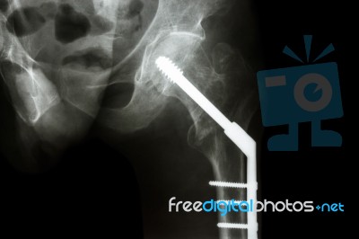 Fracture Neck Of Femur(thigh's Bone). Patient Was Operated And F… Stock Photo