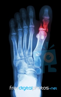 Fracture Proximal Phalange At First Toe Stock Photo