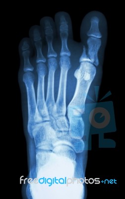 Fracture Proximal Phalange At First Toe Stock Photo