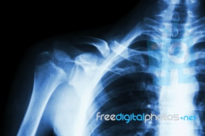 Fracture Right Clavicle Stock Photo