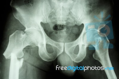 Fracture Right Femur (thigh's Bone) Stock Photo