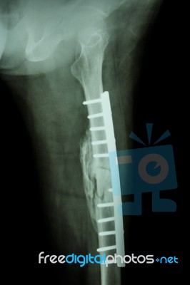 Fracture Shaft Of Femur. It Was Operated And Internal Fixation B… Stock Photo