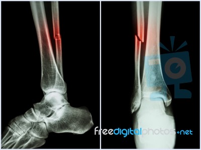 Fracture Shaft Of Fibula Bone ( Leg Bone ) .  X-ray Of Leg ( 2 Position : Side And Front View ) Stock Photo