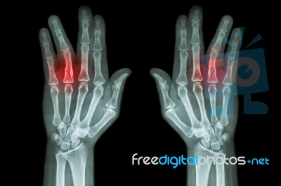 Fracture Shaft Of Proximal Phalange Of Ring Finger ( Film X-ray Both Hand Ap ) Stock Photo