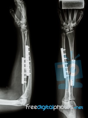 Fracture Shaft Of Radius & Ulnar Bone. It Was Operated And Inter… Stock Photo