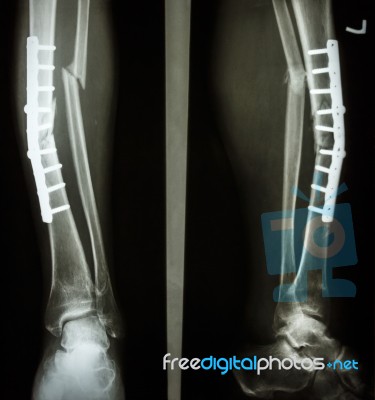 Fracture Shaft Of Tibia And Fibula Stock Photo