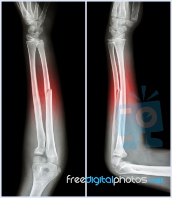 Fracture Shaft Of Ulnar Bone ( Forearm Bone )  :  ( Front And Side View ) Stock Photo