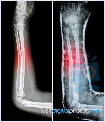 Fracture Shaft Of Ulnar Bone ( Forearm Bone )  : ( Left : Pre-treatment  ,  Right : Psot-treatment (splint With Cast) ) Stock Photo