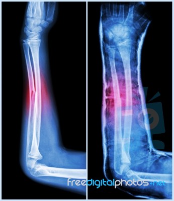 Fracture Shaft Of Ulnar Bone ( Forearm Bone )  : ( Left : Pre-treatment  ,  Right : Psot-treatment (splint With Cast) ) Stock Photo