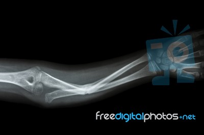 Fracture Shaft Of Ulnar(forearm's Bone) Stock Photo