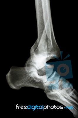 Fracture Tibia & Fibula (leg's Bone) And Ankle Dislocation Stock Photo