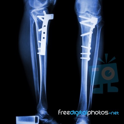 Fracture Tibia(leg Bone) Stock Photo