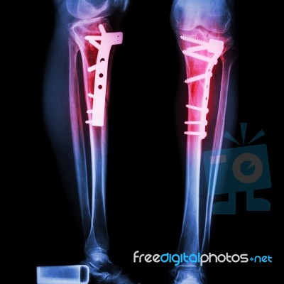 Fracture Tibia(leg Bone) Stock Photo