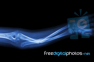 Fracture Ulnar Bone (forearm Bone) Stock Photo