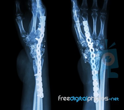 Fracture Wrist And Chronic Infection. It Was Operated And Intern… Stock Photo