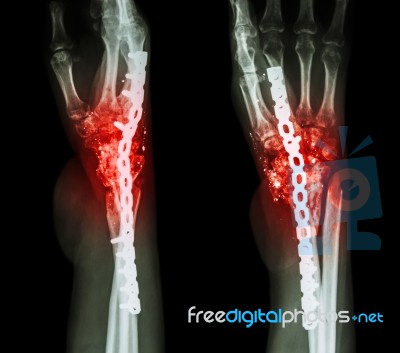 Fracture Wrist And Chronic Infection. It Was Operated And Intern… Stock Photo