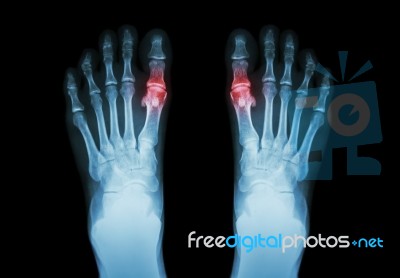 Gout , Rheumatoid Arthritis ( Film X-ray Both Foot And Arthritis At First Metatarsophalangeal Joint ) ( Medicine And Science Background ) Stock Photo