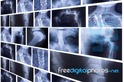 Group Of X-rays On Light Board Stock Photo - Royalty Free Image ID ...