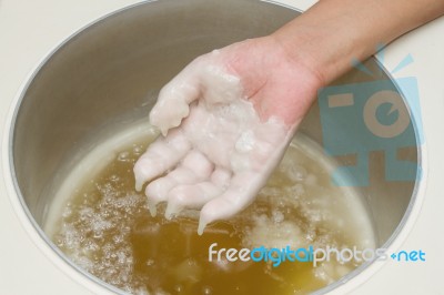 Hand In Parrafin Bath Stock Photo