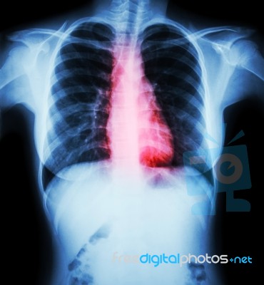 Heart Disease ( Film Chest X-ray Of Woman With Heart Disease ) Stock Photo