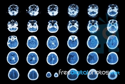 Hemorrhagic Stroke And Ischemic Stroke .  Ct Scan Of Brain : Intracerebral Hemorrhage ( 3 Left Column , Cerebral Infarction ( 3 Right Column )) ( Medical And Science Background ) Stock Photo