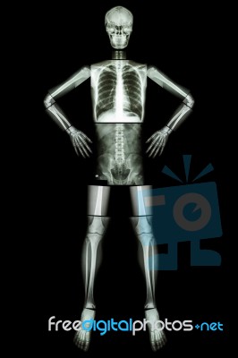 Human Bone Stand And Akimbo (x-ray Whole Body : Head Skull Neck Spine Shoulder Arm Elbow Forearm Wrist Hand Finger Chest Thorax Heart Lung Abdomen Back Vertebra Pelvis Hip Thigh Knee Leg Ankle Foot ) Stock Photo