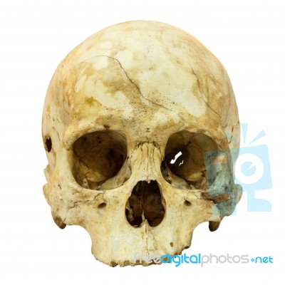 Human Skull Fracture (mongoloid,asian) On Isolated Background Stock Photo