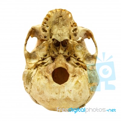 Human Skull Fracture(beneath) (mongoloid,asian) On Isolated Back… Stock Photo