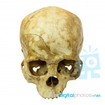 Human Skull Fracture(top Side,apex)(mongoloid,asian) On Isolated… Stock Photo