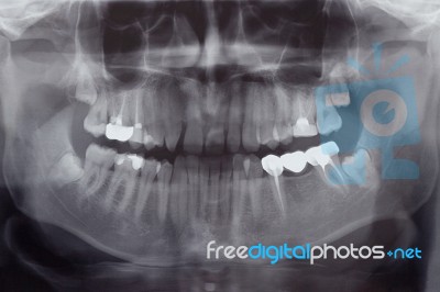 Human Teeth, X-ray Stock Photo