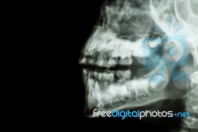 Human's Jaw And Teeth Stock Photo