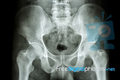 Human's Pelvis And Hip Joints Stock Photo