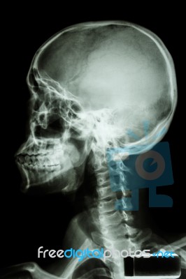 Human's Skull And Cervical Spine Stock Photo