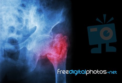 Intertrochanteric ( Neck Of Femur ) Fracture Left Femur ( Thigh Bone ) And Blank Area At Right Side Stock Photo