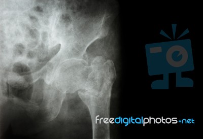 Intertrochanteric ( Neck Of Femur ) Fracture Left Femur ( Thigh Bone ) And Blank Area At Right Side Stock Photo