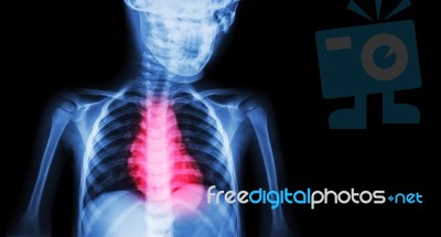 Ischemic Heart Disease , Myocardial Infarction ( Mi ) ( Film X-ray Body Of Human With Heart Disease And Blank Area At Right Side ) ( Cardiopulmonary Resuscitate And Cardiovascular Concept ) Stock Photo