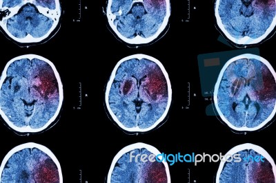 Ischemic Stroke : ( Ct Of Brain Show Cerebral Infarction At Left Frontal - Temporal - Parietal Lobe ) ( Nervous System Background ) Stock Photo