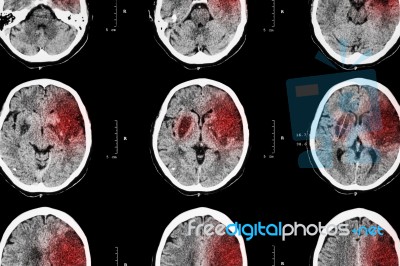 Ischemic Stroke : ( Ct Of Brain Show Cerebral Infarction At Left Frontal - Temporal - Parietal Lobe ) ( Nervous System Background ) Stock Photo