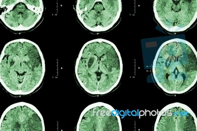 Ischemic Stroke : ( Ct Of Brain Show Cerebral Infarction At Left Frontal - Temporal - Parietal Lobe ) ( Nervous System Background ) Stock Photo