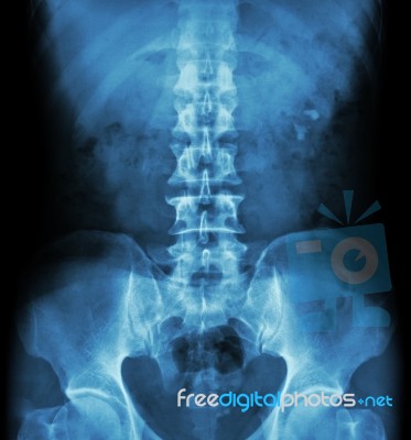 Kidney Stone ( Renal Stone , Renal Calculi ) ( Film X-ray Kub ( Kidney - Ureter - Bladder ) Show Left Renal Stone ) Stock Photo